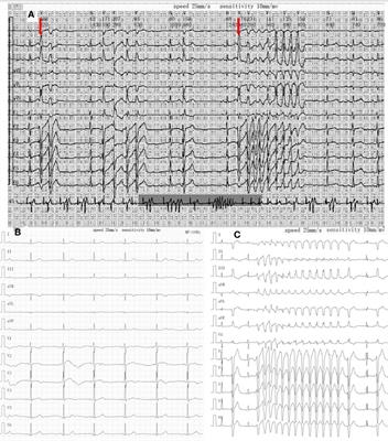 Frequent torsades de pointes in a child with novel AKAP9 mutation: A case report and literature review